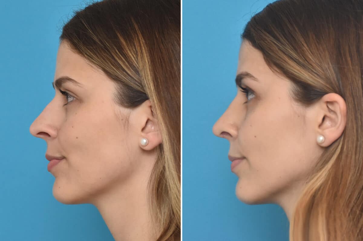 Rhinoplasty Before and After Photos in Philadelphia, PA, Patient 4594