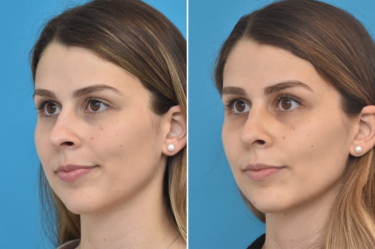 Rhinoplasty Before and After Photos in Philadelphia, PA, Patient 4594