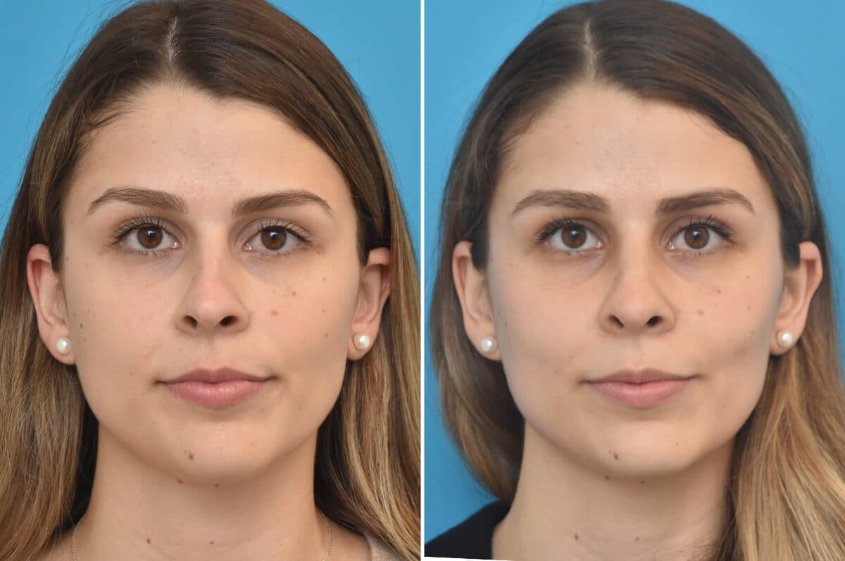 Rhinoplasty Before and After Photos in Philadelphia, PA, Patient 4594