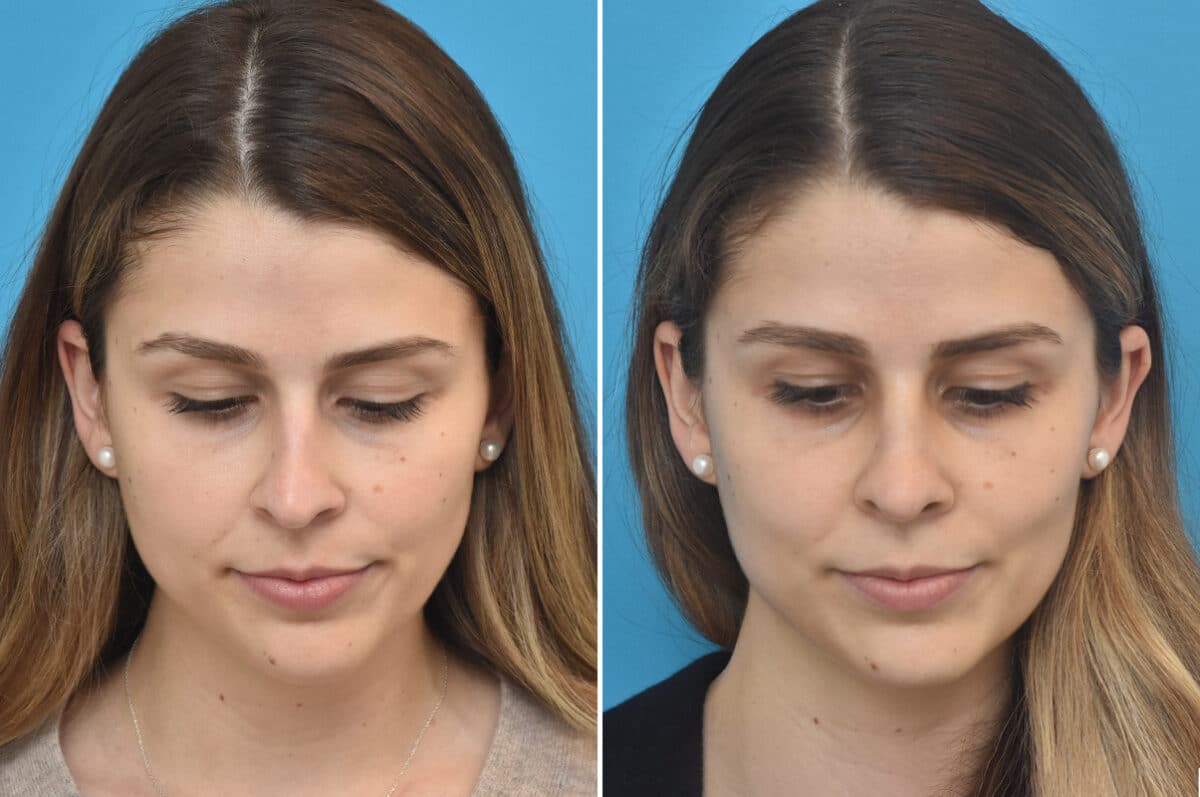 Rhinoplasty Before and After Photos in Philadelphia, PA, Patient 4594