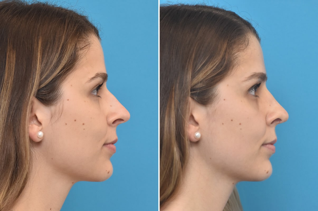 patient-4594-rhinoplasty-before-after