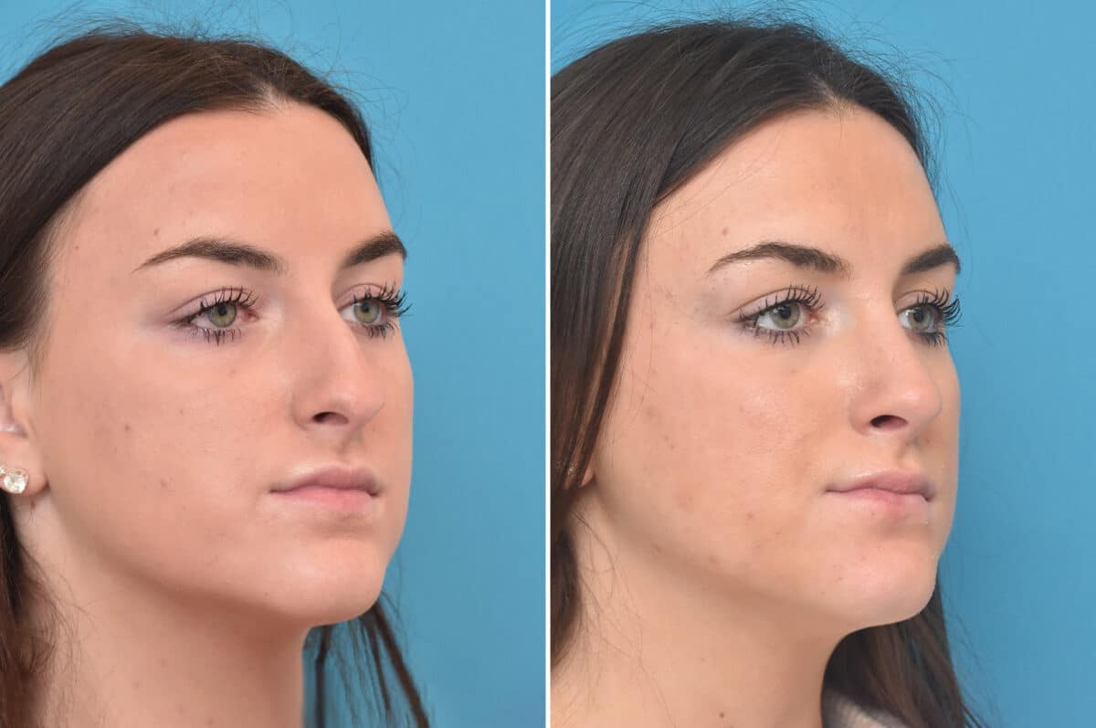 Rhinoplasty Before and After Photos in Philadelphia, PA, Patient 4623