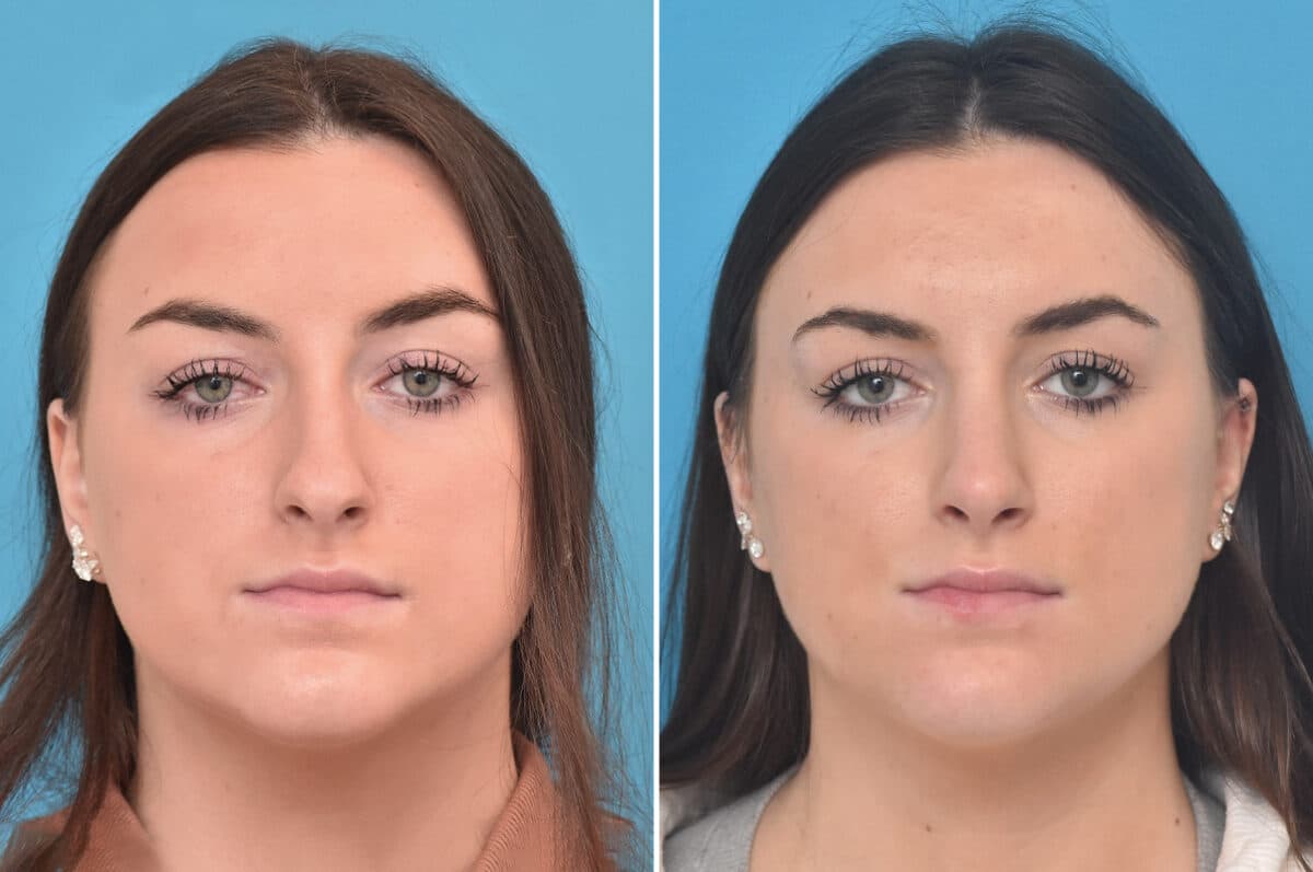 Rhinoplasty Before and After Photos in Philadelphia, PA, Patient 4623