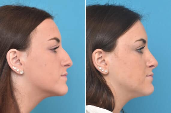 Rhinoplasty Before and After Photos in Philadelphia, PA, Patient 4623