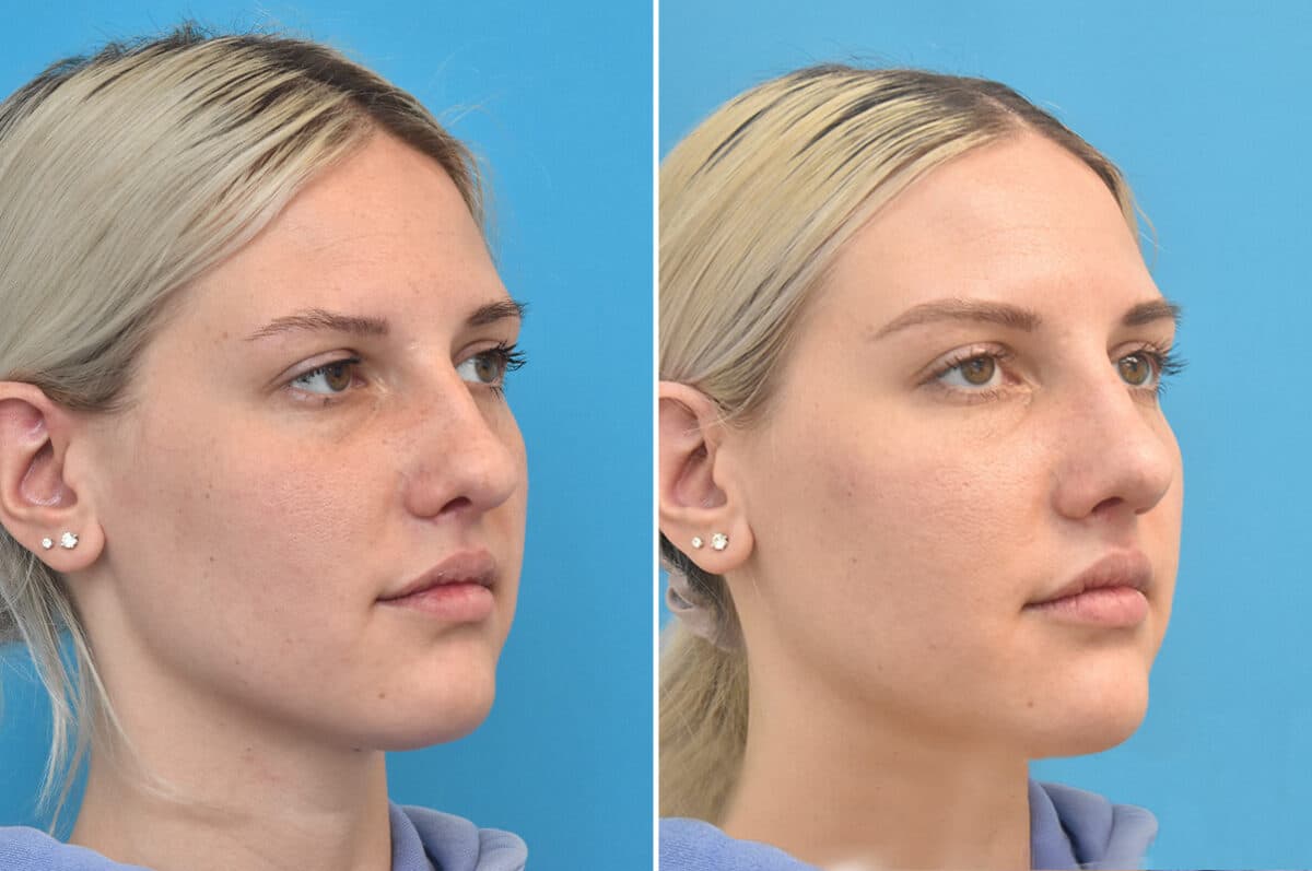 Rhinoplasty Before and After Photos in Philadelphia, PA, Patient 4624