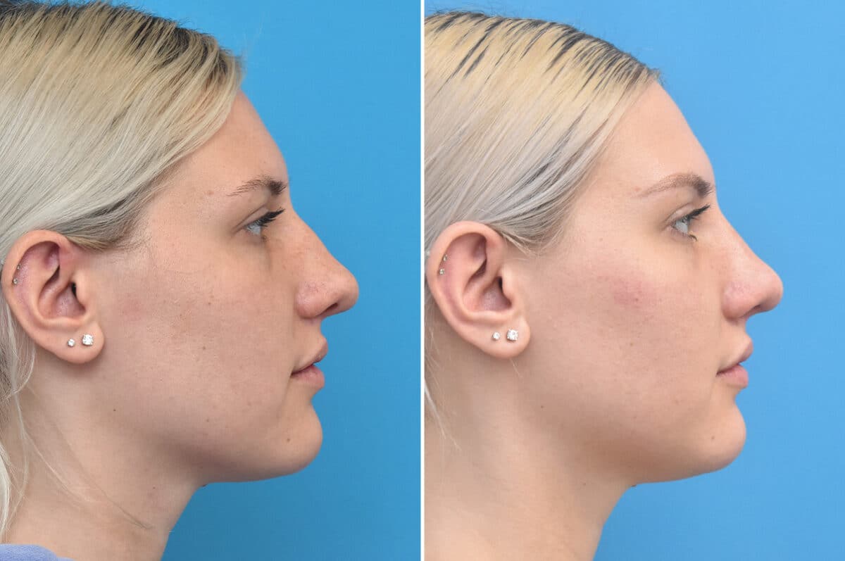 Rhinoplasty Before and After Photos in Philadelphia, PA, Patient 4624