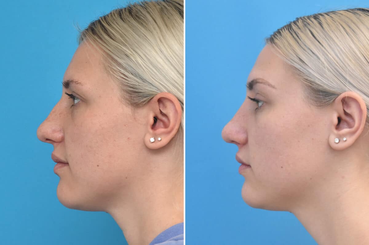 Rhinoplasty Before and After Photos in Philadelphia, PA, Patient 4624