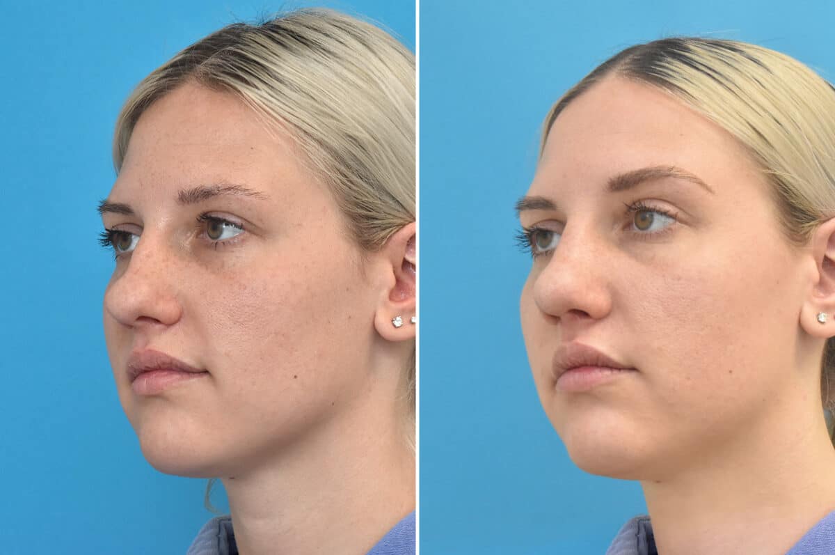 Rhinoplasty Before and After Photos in Philadelphia, PA, Patient 4624