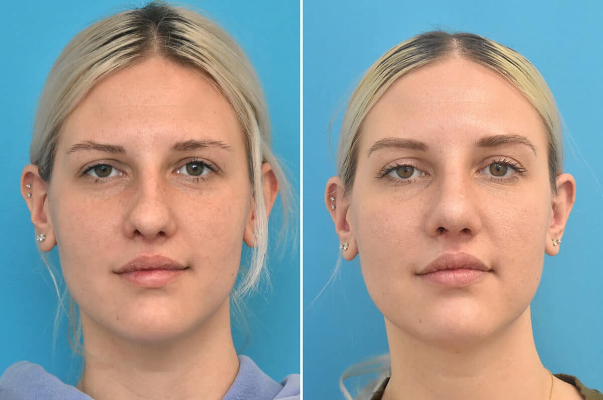 Rhinoplasty Before and After Photos in Philadelphia, PA, Patient 4624