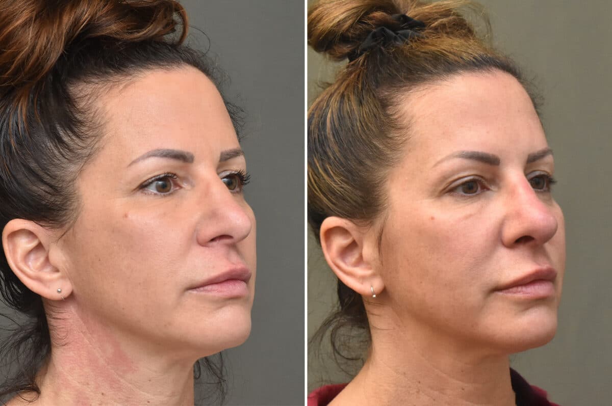 Rhinoplasty Before and After Photos in Philadelphia, PA, Patient 4625