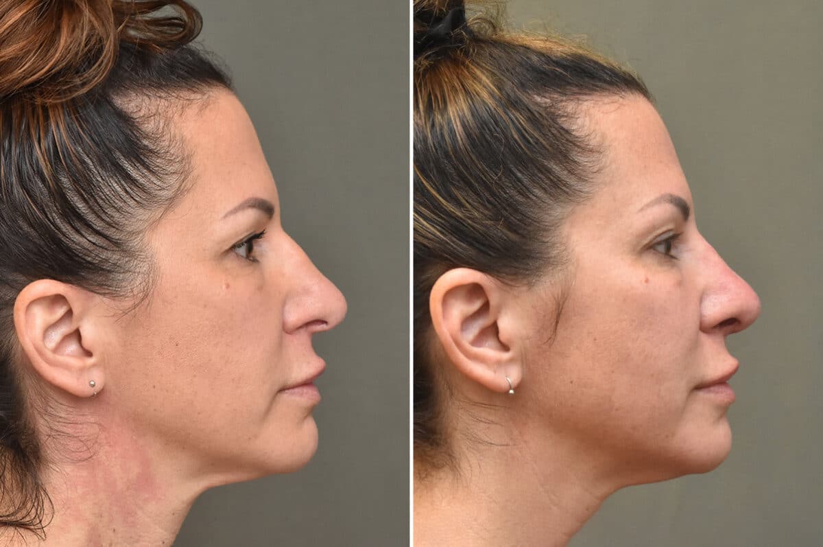 Rhinoplasty Before and After Photos in Philadelphia, PA, Patient 4625