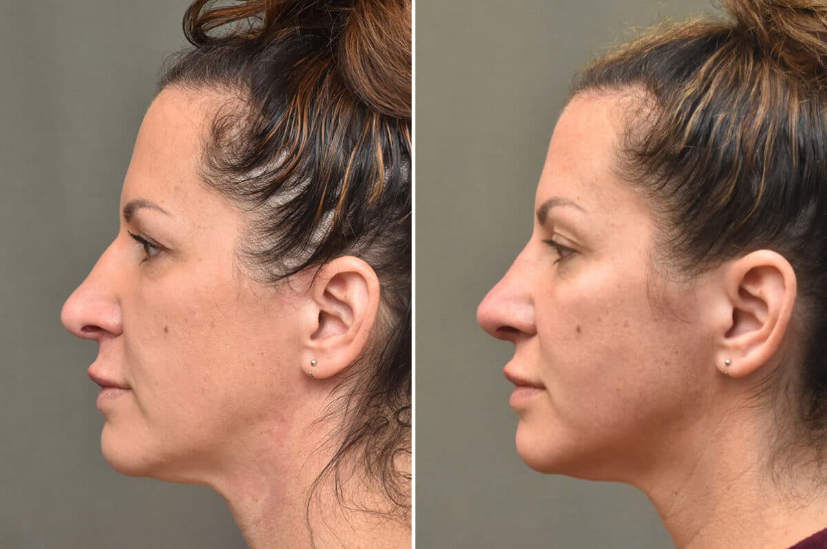 Rhinoplasty Before and After Photos in Philadelphia, PA, Patient 4625