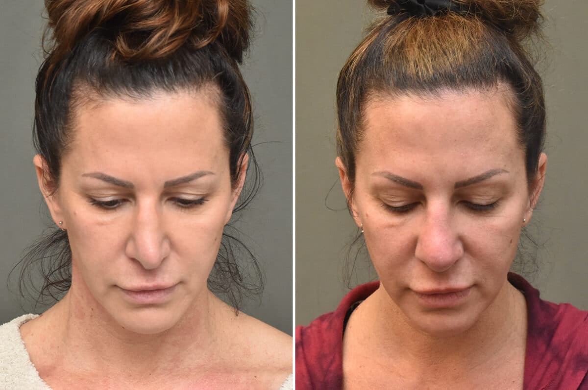 Rhinoplasty Before and After Photos in Philadelphia, PA, Patient 4625