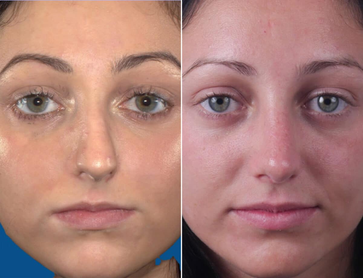 Nasal Bump Before and After Photos in Sewell, NJ, Patient 1581