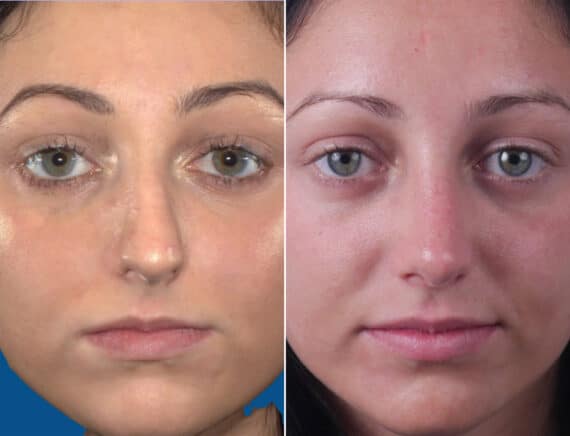 Nasal Bump Before and After Photos in Sewell, NJ, Patient 1581