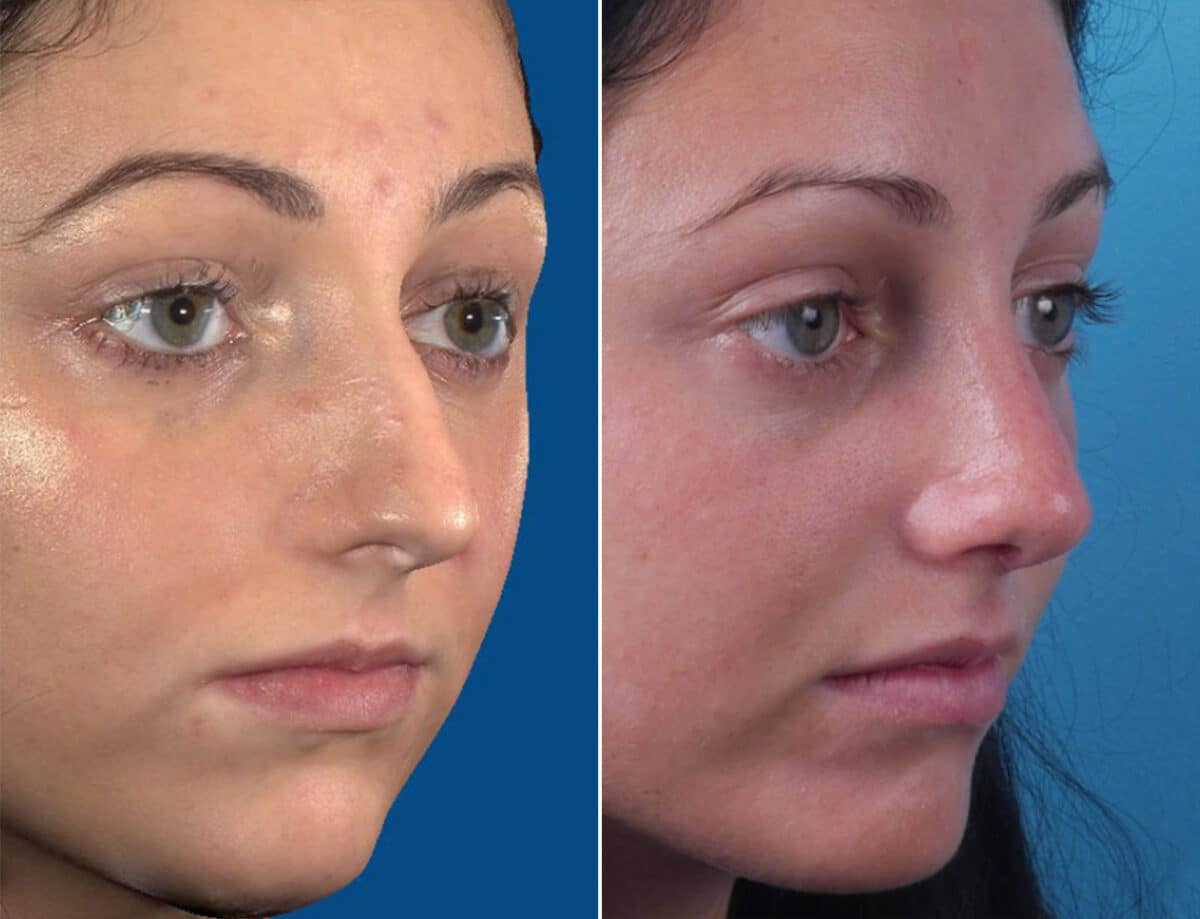 Nasal Bump Before and After Photos in Sewell, NJ, Patient 1581