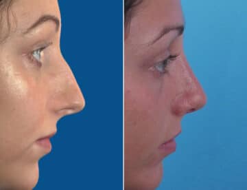 Nasal Bump Before and After Photos in Sewell, NJ, Patient 1581