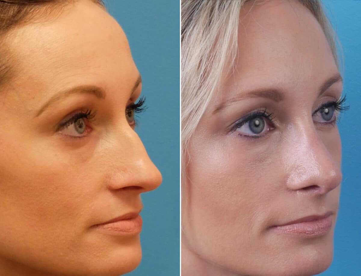 Large Nose Before and After Photos in Sewell, NJ, Patient 1601