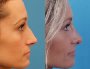 Large Nose Before and After Photos in Sewell, NJ, Patient 1601