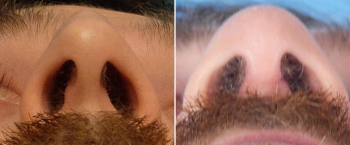 Nasal Bump Before and After Photos in Sewell, NJ, Patient 1618