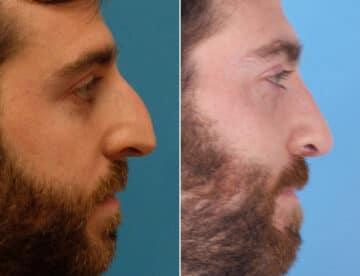 Nasal Bump Before and After Photos in Sewell, NJ, Patient 1618