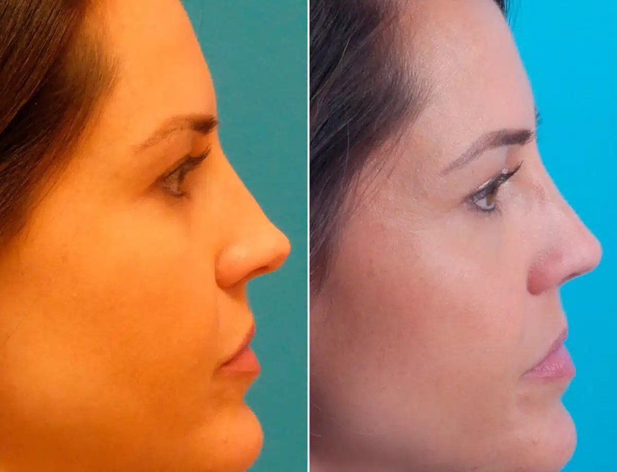 Overprojected Before and After Photos in Sewell, NJ, Patient 1628