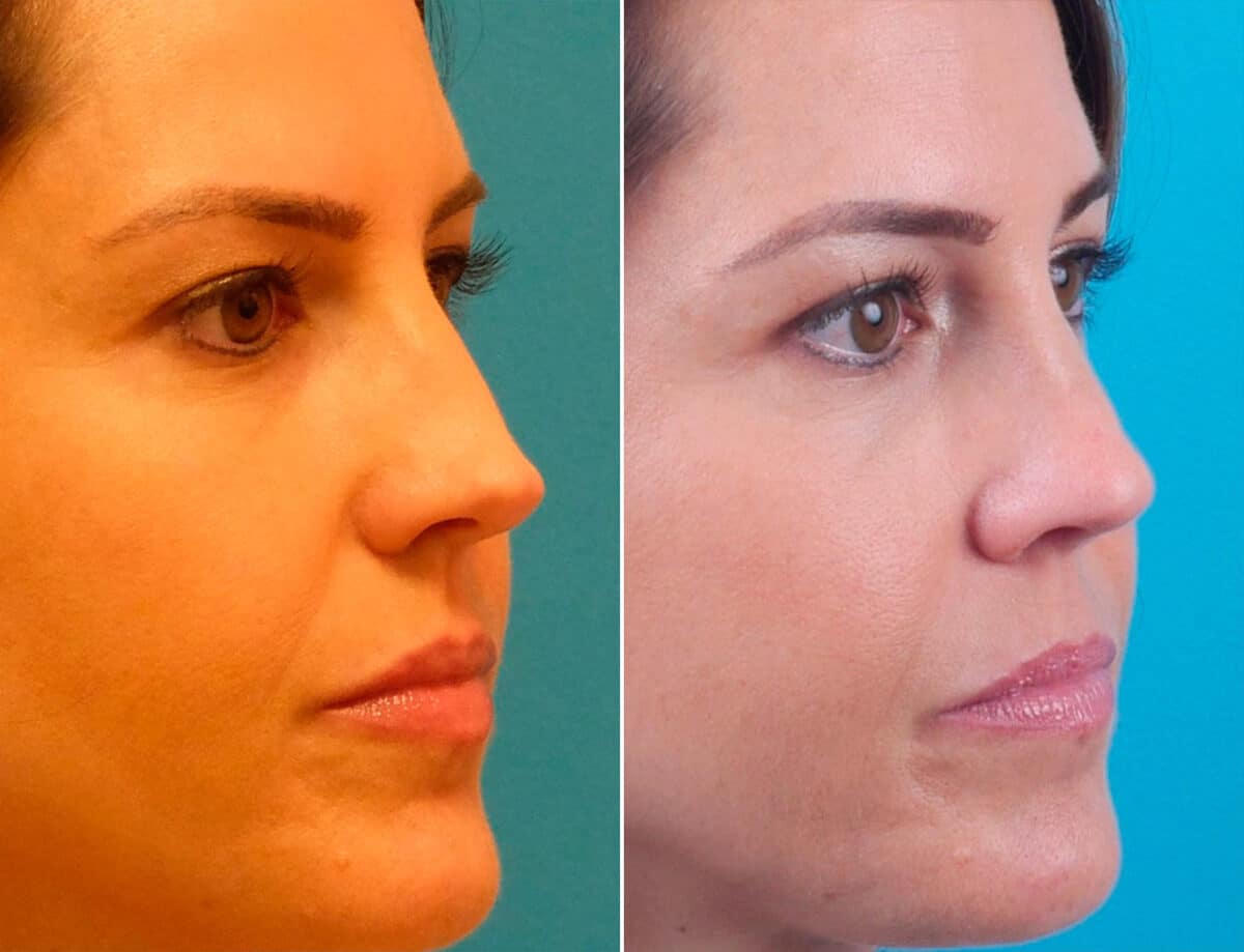 Overprojected Before and After Photos in Sewell, NJ, Patient 1628