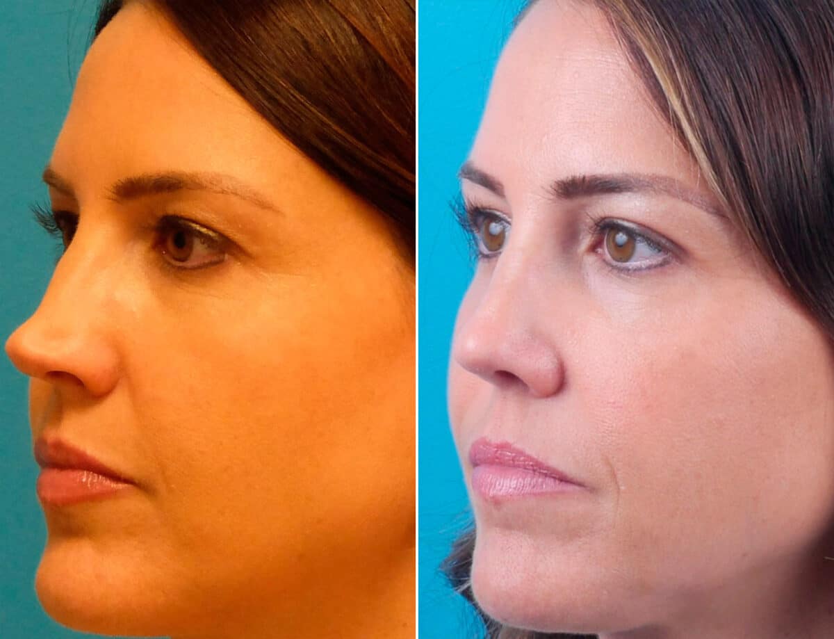 Overprojected Before and After Photos in Sewell, NJ, Patient 1628