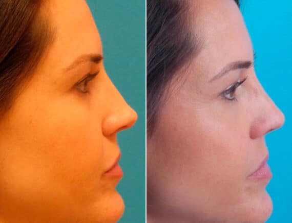 Overprojected Before and After Photos in Sewell, NJ, Patient 1628