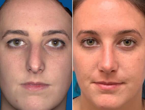 Twisted Nose Before and After Photos in Sewell, NJ, Patient 1654