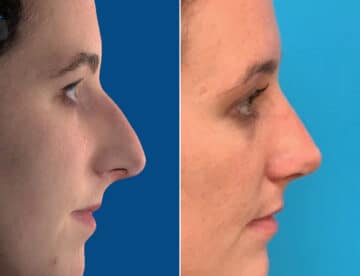 Twisted Nose Before and After Photos in Sewell, NJ, Patient 1654