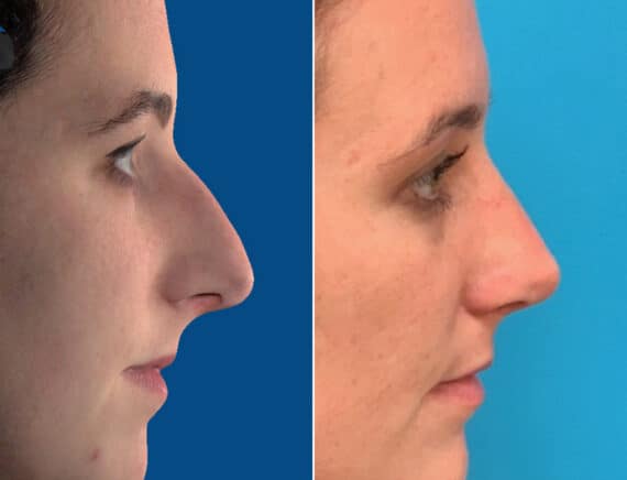 Nasal Bump Before and After Photos in Sewell, NJ, Patient 1654