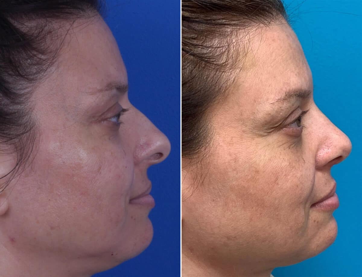 Bulbous Tip Before and After Photos in Sewell, NJ, Patient 1688