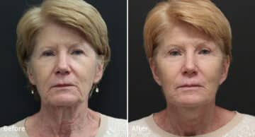 Neck Lift Before and After Photos in Princeton, NJ, Patient 394