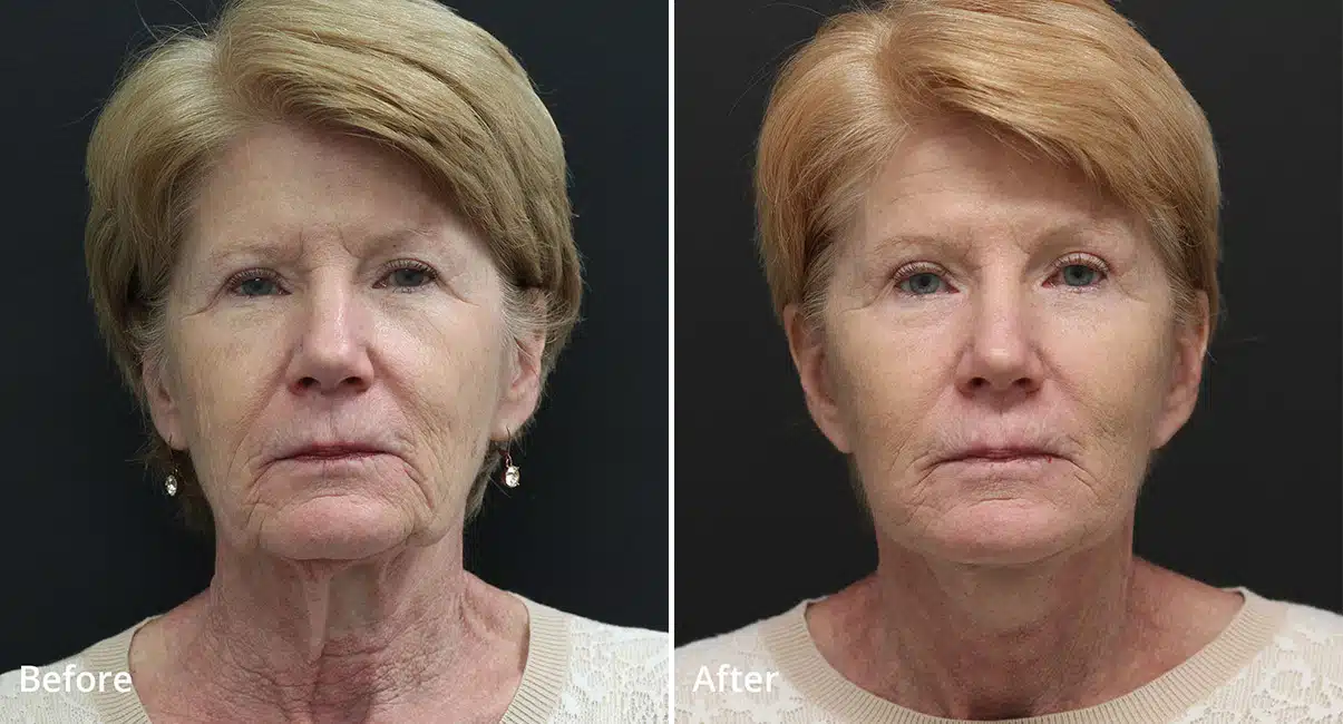 Facial Fat Grafting Before & After photos