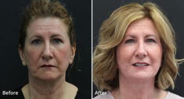 Neck Lift Before and After Photos in Princeton, NJ, Patient 404