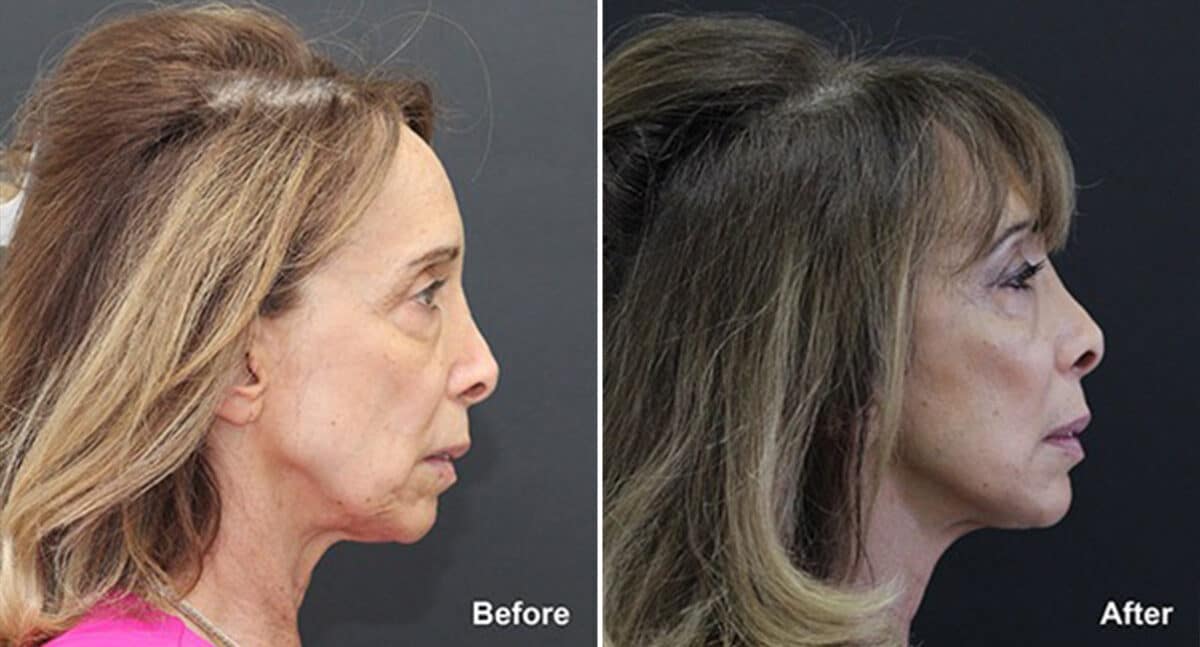 Patient 444, Fat Transfer Before and After Photos Fat Transfer Before and After Photos in Princeton, NJ, Patient 444