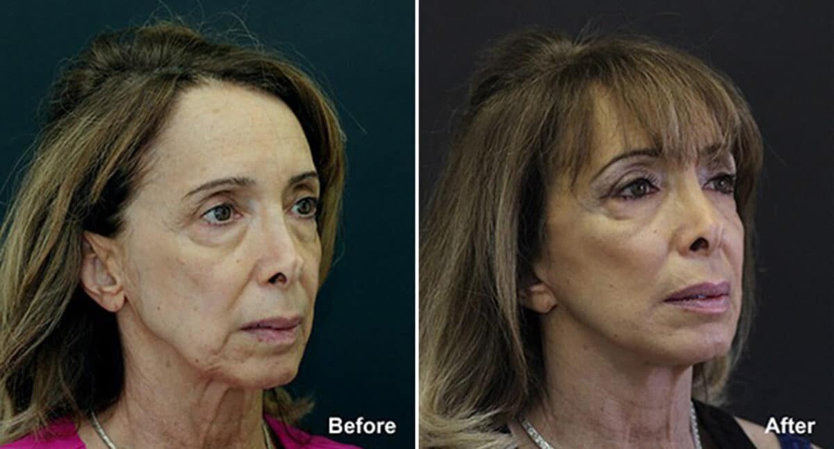 Patient 444, Fat Transfer Before and After Photos Fat Transfer Before and After Photos in Princeton, NJ, Patient 444