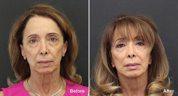 Neck Lift Before and After Photos in Princeton, NJ, Patient 444