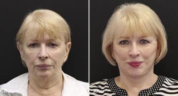 Neck Lift Before and After Photos in Princeton, NJ, Patient 455