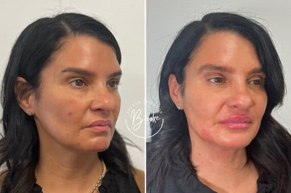 Injectable Fillers Before and After Photos in Philadelphia, PA, Patient 4732