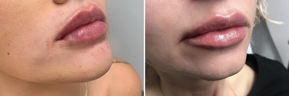 Injectable Fillers Before and After Photos in Philadelphia, PA, Patient 4736