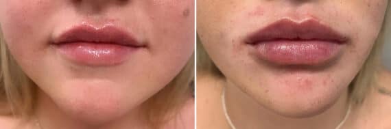 Injectable Fillers Before and After Photos in Philadelphia, PA, Patient 4736