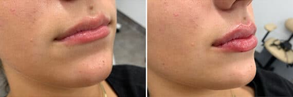 Injectable Fillers Before and After Photos in Philadelphia, PA, Patient 4737