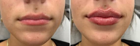 Injectable Fillers Before and After Photos in Philadelphia, PA, Patient 4737