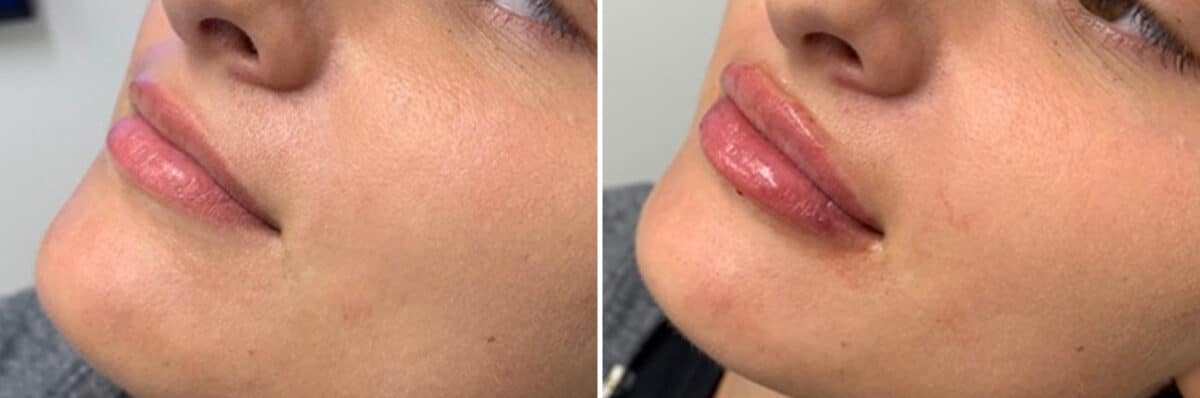 Injectable Fillers Before and After Photos in Philadelphia, PA, Patient 4738