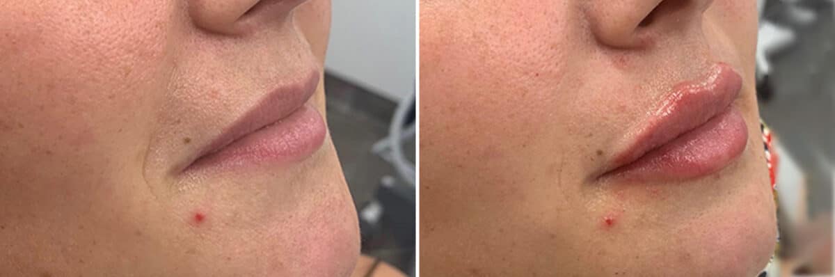 Injectable Fillers Before and After Photos in Philadelphia, PA, Patient 4738