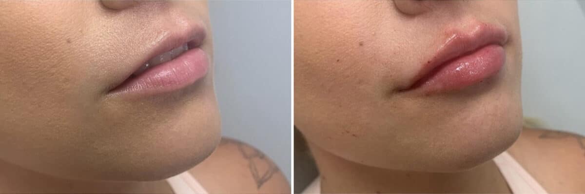 Injectable Fillers Before and After Photos in Philadelphia, PA, Patient 4739