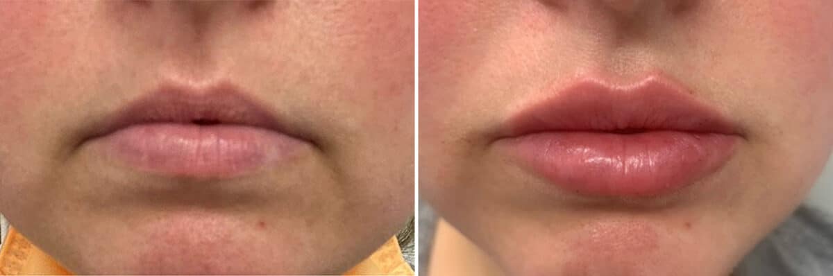 Injectable Fillers Before and After Photos in Philadelphia, PA, Patient 4740