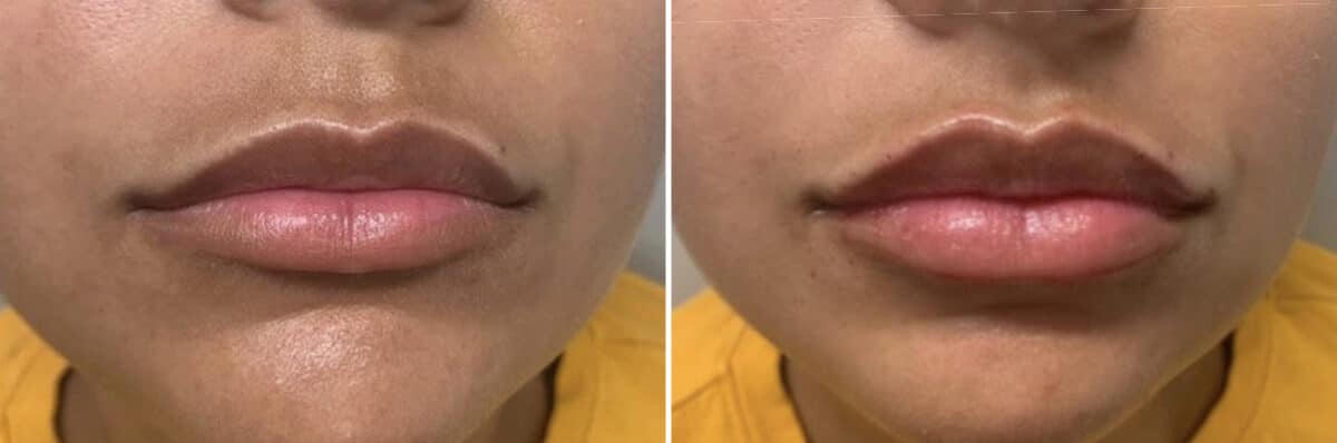 Injectable Fillers Before and After Photos in Philadelphia, PA, Patient 4741